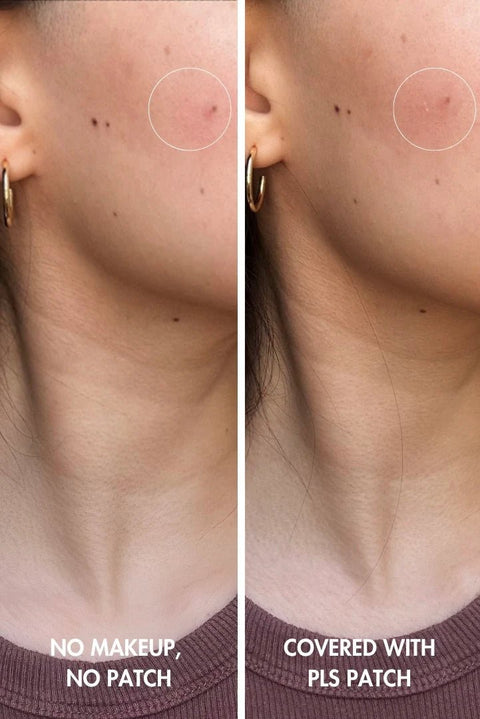 Clear Spot Pimple Dots - DK BEAUTY