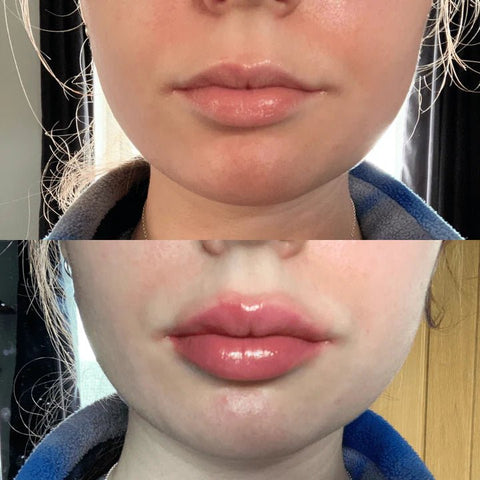 Plump It! No Needles Lip Filler Kit Original - DK BEAUTY