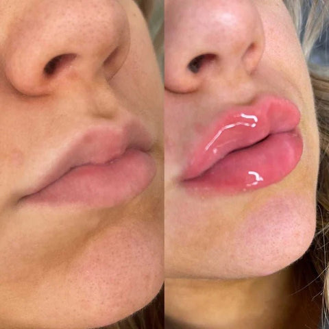 Plump It! No Needles Lip Filler Kit Original - DK BEAUTY