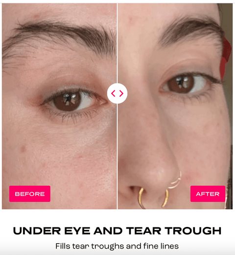 Plump It! No Needles Dermal Filler (30 applications) - DK BEAUTY