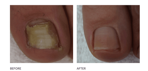 Footlogix Anti - Fungal Nail Tincture Spray - DK BEAUTY