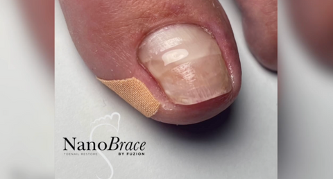 NanoBrace by Fuzion: The Non-Surgical Solution for Involuted Toenails Your Clients Have Been Waiting For