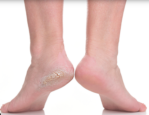 Before and after cracked heel treatment — Footlogix professional foot care