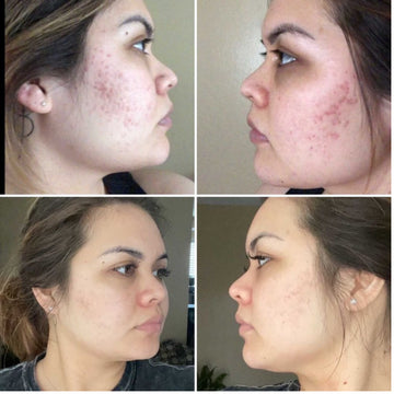 Dr. Pen M8S Micro-needling Device Kit (17 Piece)