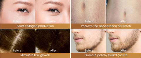 Dr. Pen M8S Micro-needling Device Kit (17 Piece)