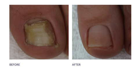 Nail Treatments
