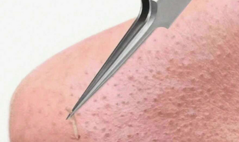 Extremely Pointed Tip Tweezers for Blackheads
