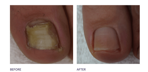 Footlogix Anti-Fungal Nail Tincture (#7T)