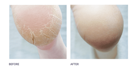 Footlogix Cracked Heel 3+ - DK BEAUTY